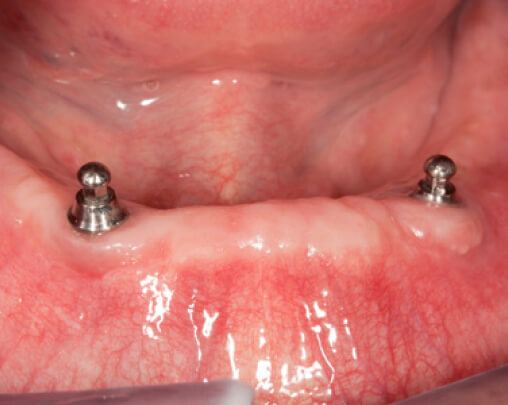 Dental Implants - People With Loose Dentures Or Partials