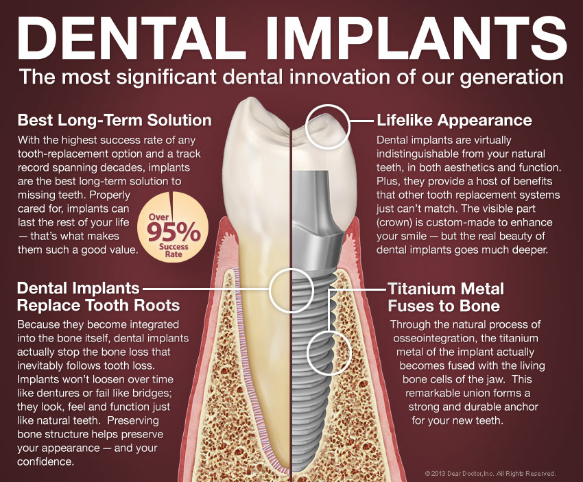 Dental Implants FAQs - NKC Dental