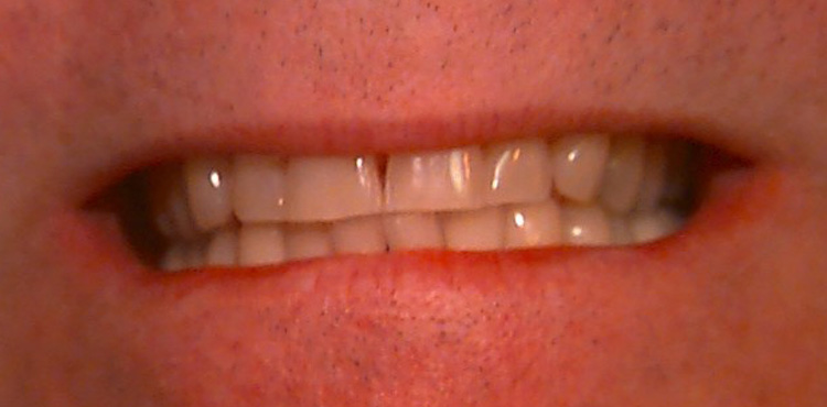 Teeth Whitening Case 1 before