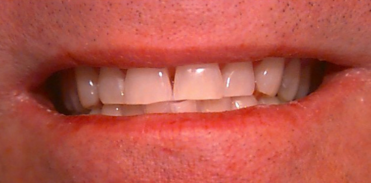 Teeth Whitening Case 1 after