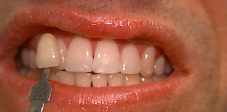 Teeth Whitening Case 2 before