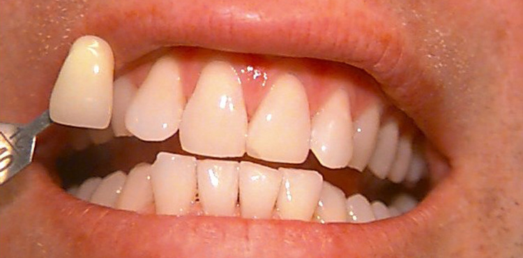 Teeth Whitening Case 3 After